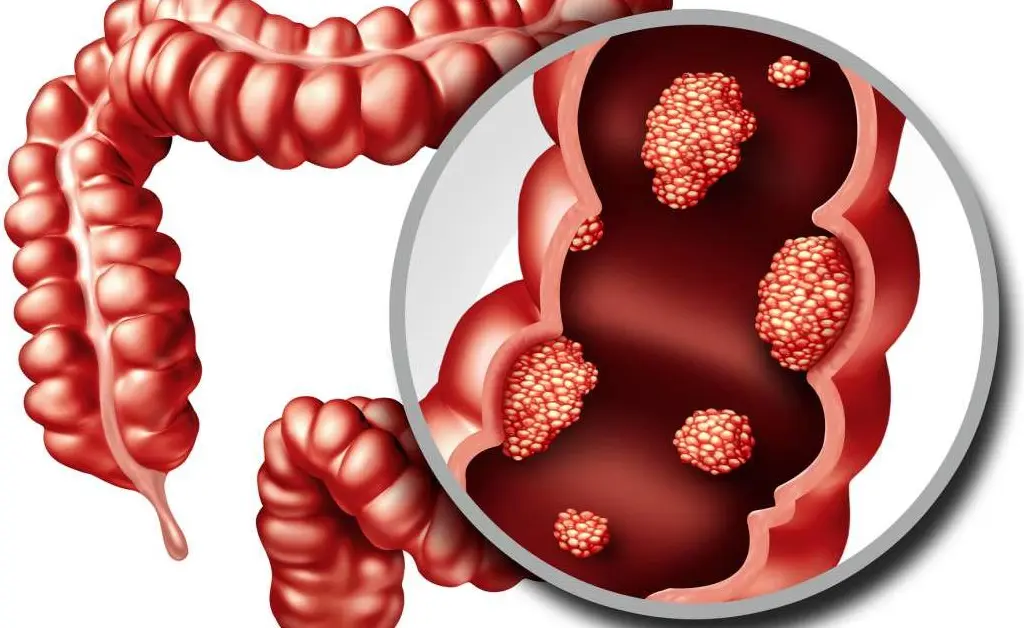 Discovery Drugs Block Protein that Ensures Bowel Cancer Growth