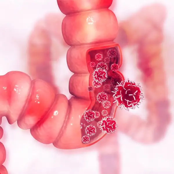 discovery drug that blocks protein that promotes bowel cner