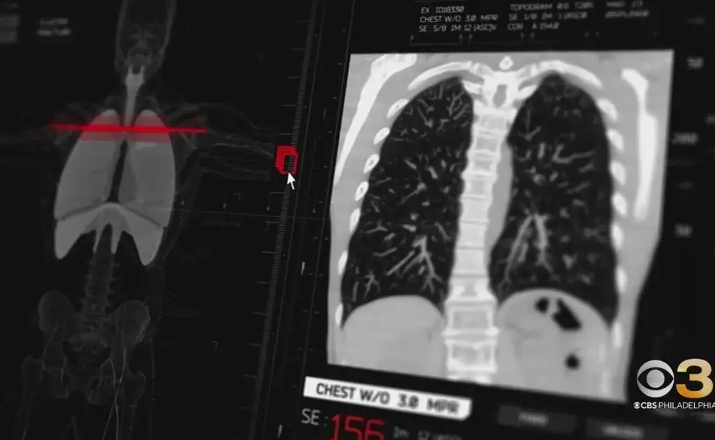 Robotic Technology That Can Discover Lung Cancer Early